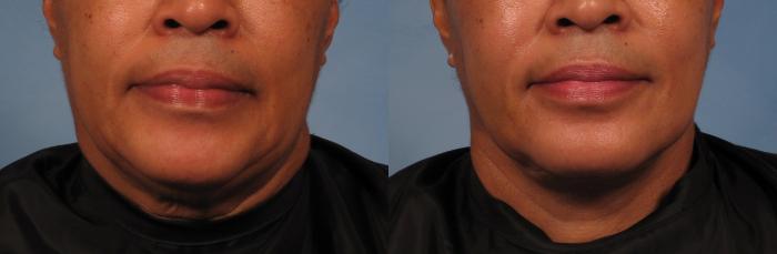 Before & After Laser Neck Lift - Precision Tx Case 265 View #3 View in Naples and Ft. Myers, FL