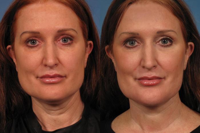 Before & After Laser Neck Lift - Precision Tx Case 280 View #1 View in Naples and Ft. Myers, FL