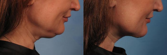 Before & After Laser Neck Lift - Precision Tx Case 280 View #4 View in Naples and Ft. Myers, FL