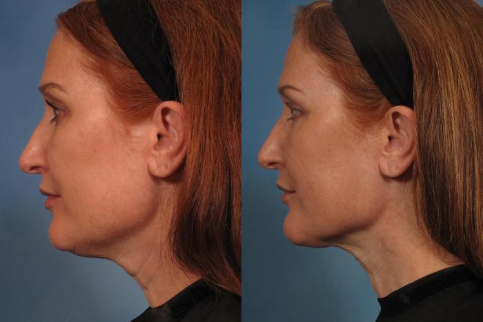 Before & After Laser Neck Lift - Precision Tx Case 280 View #5 View in Naples and Ft. Myers, FL