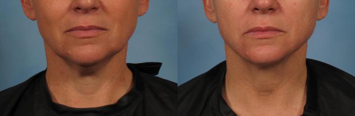 Before & After Laser Neck Lift - Precision Tx Case 281 View #1 View in Naples and Ft. Myers, FL