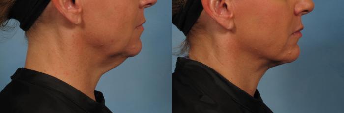 Before & After Laser Neck Lift - Precision Tx Case 281 View #2 View in Naples and Ft. Myers, FL
