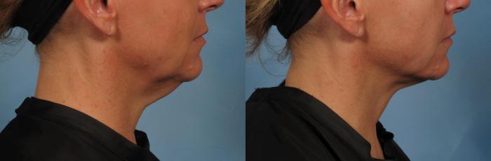 Before & After Laser Neck Lift - Precision Tx Case 281 View #3 View in Naples and Ft. Myers, FL