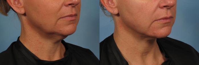 Before & After Laser Neck Lift - Precision Tx Case 281 View #4 View in Naples and Ft. Myers, FL