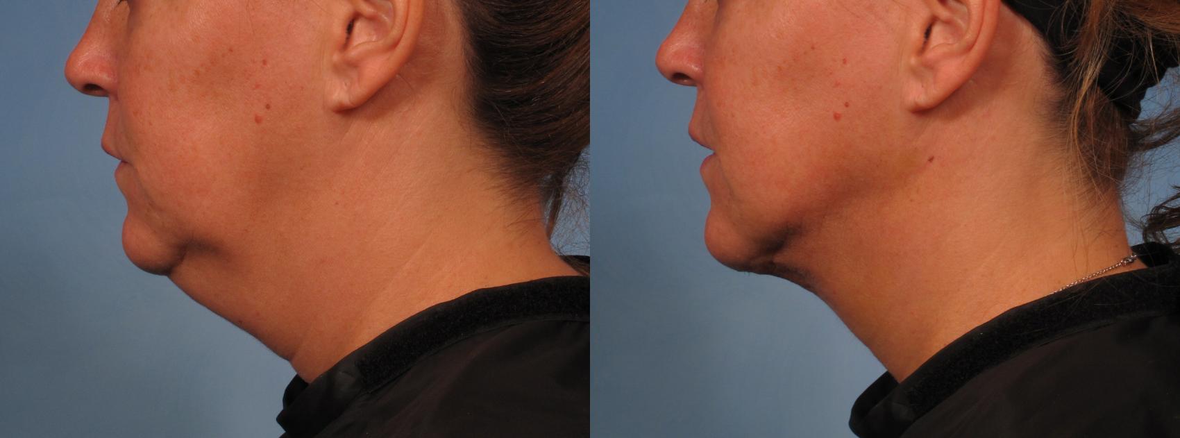 Before & After Laser Neck Lift - Precision Tx Case 282 View #1 View in Naples and Ft. Myers, FL