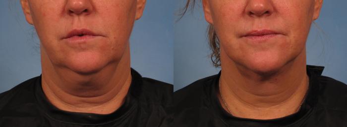 Before & After Laser Neck Lift - Precision Tx Case 282 View #3 View in Naples and Ft. Myers, FL