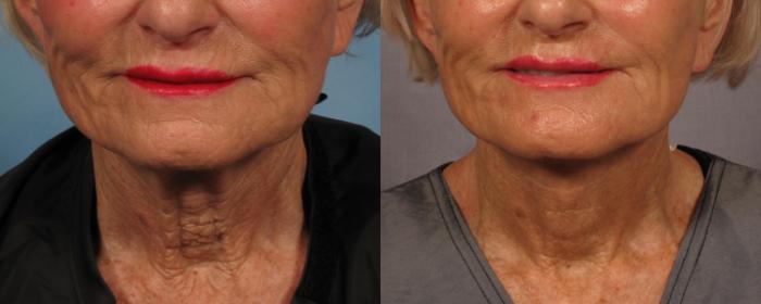 Before & After Laser Neck Lift - Precision Tx Case 285 View #1 View in Naples and Ft. Myers, FL