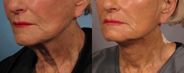 Before & After Laser Neck Lift - Precision Tx Case 285 View #2 View in Naples and Ft. Myers, FL
