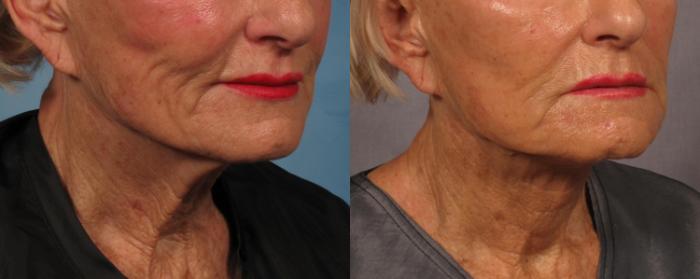 Before & After Laser Neck Lift - Precision Tx Case 285 View #3 View in Naples and Ft. Myers, FL