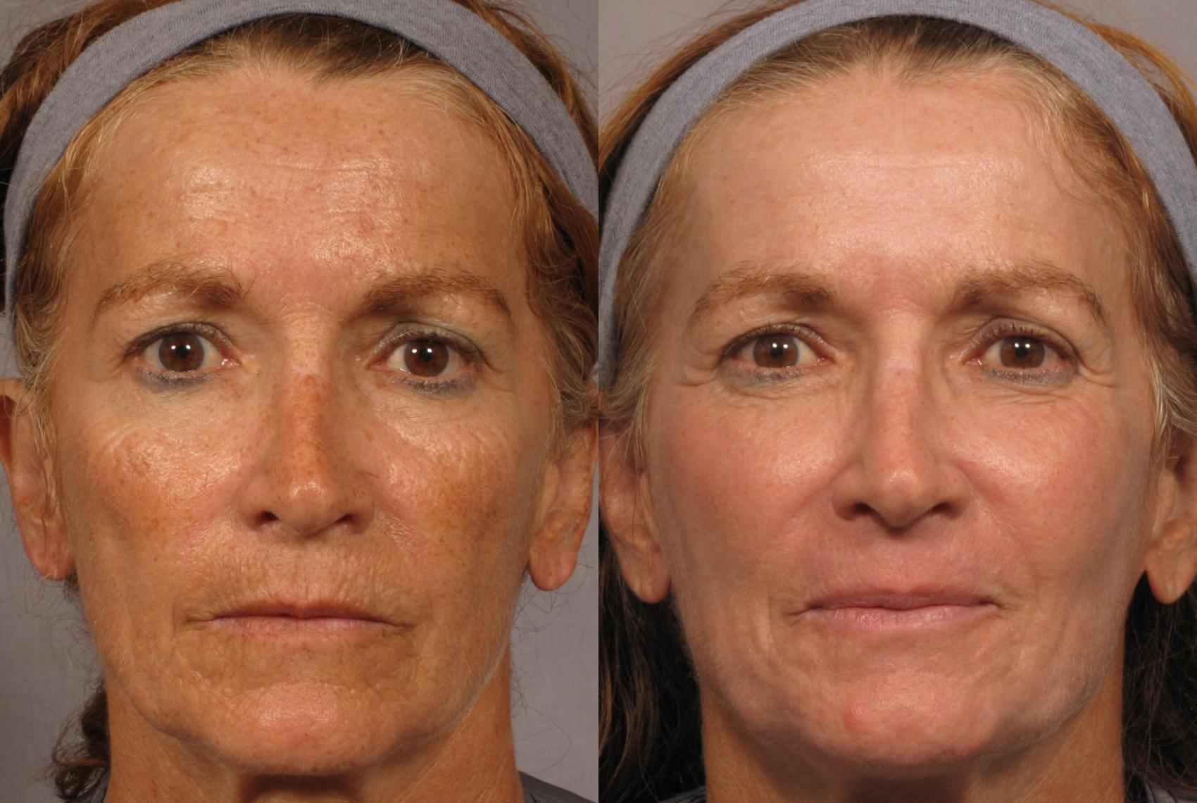 Before & After Laser Resurfacing - Total FX Case 316 View #1 View in Naples and Ft. Myers, FL