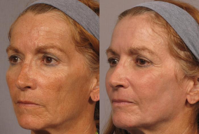 Before & After Laser Resurfacing - Total FX Case 316 View #2 View in Naples and Ft. Myers, FL