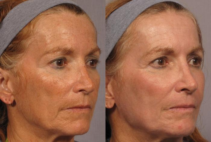 Before & After Laser Resurfacing - Total FX Case 316 View #3 View in Naples and Ft. Myers, FL