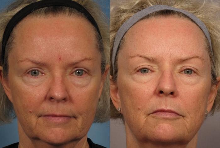 Before & After Laser Resurfacing - Total FX Case 317 View #1 View in Naples and Ft. Myers, FL