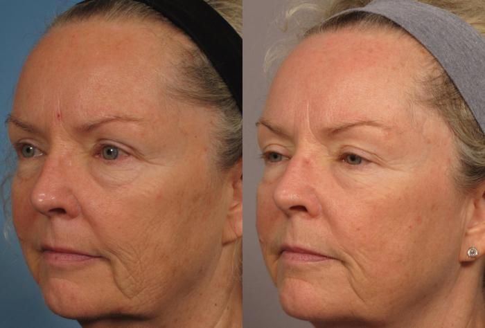 Before & After Laser Resurfacing - Total FX Case 317 View #2 View in Naples and Ft. Myers, FL