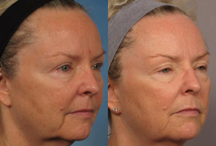 Before & After Laser Resurfacing - Total FX Case 317 View #3 View in Naples and Ft. Myers, FL