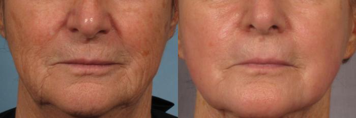 Before & After Laser Resurfacing - Total FX Case 318 View #1 View in Naples and Ft. Myers, FL