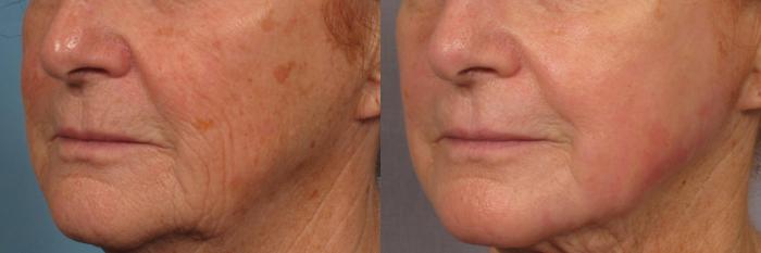 Before & After Laser Resurfacing - Total FX Case 318 View #2 View in Naples and Ft. Myers, FL