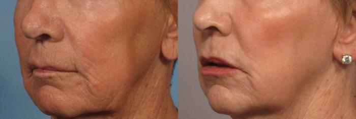 Before & After Laser Resurfacing - Total FX Case 318 View #3 View in Naples and Ft. Myers, FL