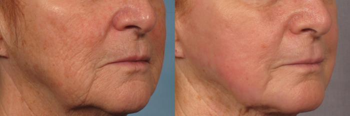 Before & After Laser Resurfacing - Total FX Case 318 View #4 View in Naples and Ft. Myers, FL