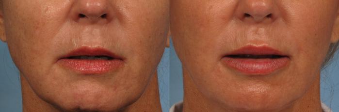 Before & After Lip Augmentation Case 201 View #1 View in Naples and Ft. Myers, FL