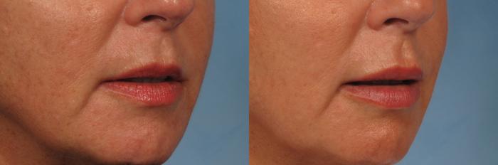 Before & After Lip Augmentation Case 201 View #2 View in Naples and Ft. Myers, FL