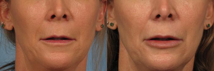 Before & After Lip Augmentation Case 242 View #1 View in Naples and Ft. Myers, FL