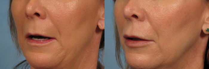Before & After Lip Augmentation Case 242 View #2 View in Naples and Ft. Myers, FL
