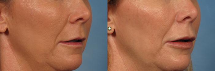 Before & After Lip Augmentation Case 242 View #3 View in Naples and Ft. Myers, FL