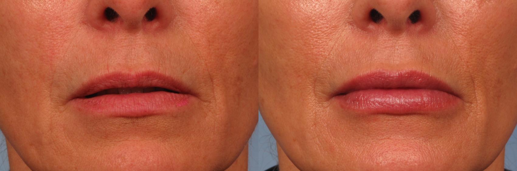 Before & After Lip Augmentation Case 243 View #1 View in Naples and Ft. Myers, FL