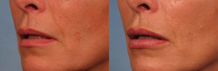 Before & After Lip Augmentation Case 243 View #2 View in Naples and Ft. Myers, FL