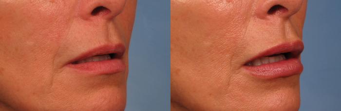 Before & After Lip Augmentation Case 243 View #3 View in Naples and Ft. Myers, FL