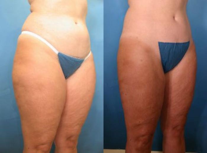 Before & After Liposuction Case 11 View #1 View in Naples and Ft. Myers, FL