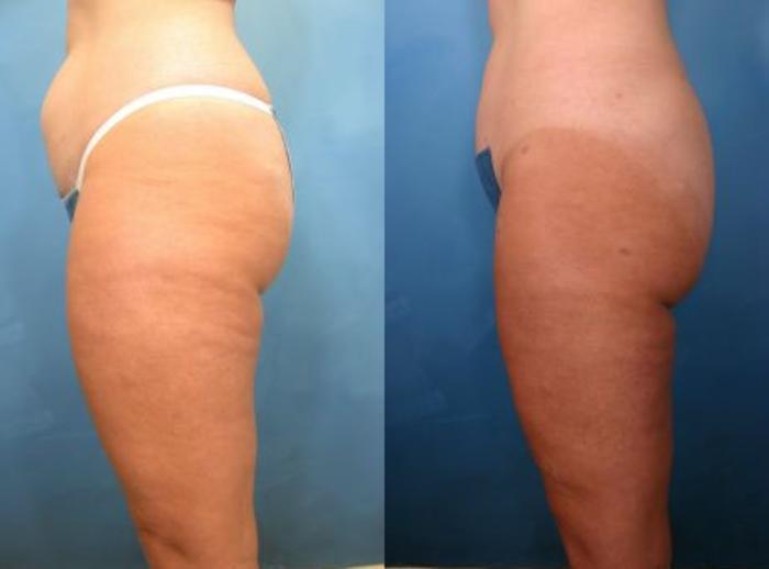 Before & After Liposuction Case 11 View #2 View in Naples and Ft. Myers, FL