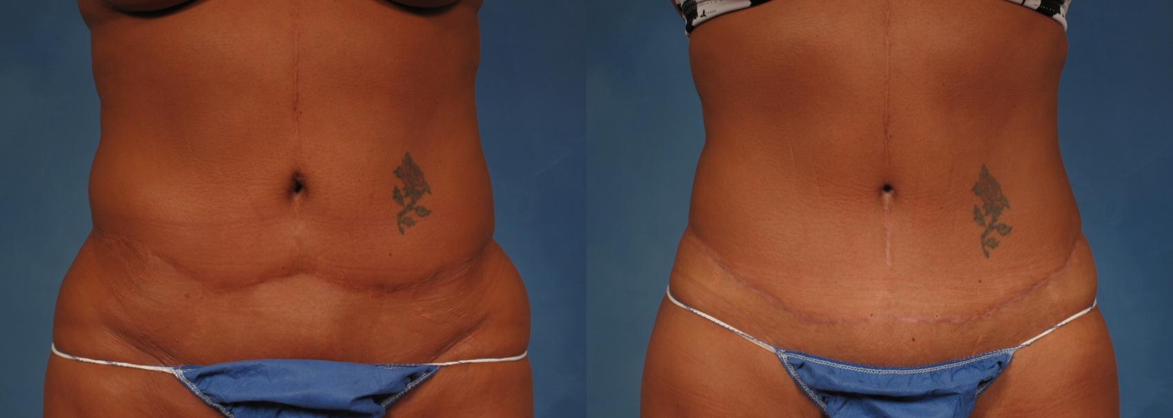 Liposuction Before and After Pictures Case 176