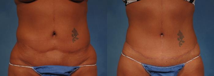 Before & After Liposuction Case 176 View #1 View in Naples and Ft. Myers, FL