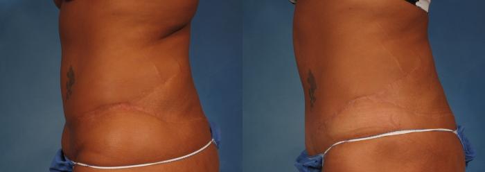 Before & After Liposuction Case 176 View #3 View in Naples and Ft. Myers, FL
