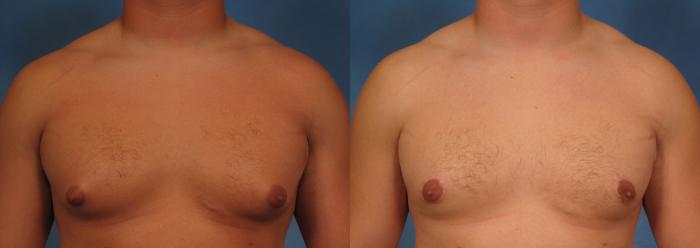 Before & After Liposuction Case 177 View #1 View in Naples and Ft. Myers, FL