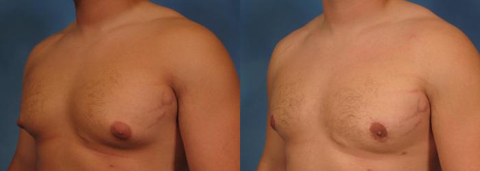 Before & After Liposuction Case 177 View #2 View in Naples and Ft. Myers, FL
