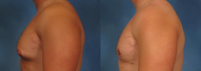 Before & After Liposuction Case 177 View #3 View in Naples and Ft. Myers, FL