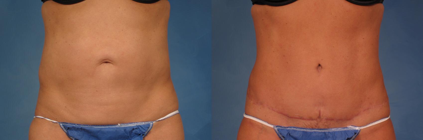 Before & After Liposuction Case 216 View #1 View in Naples and Ft. Myers, FL