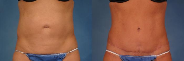 Before & After Liposuction Case 216 View #1 View in Naples and Ft. Myers, FL