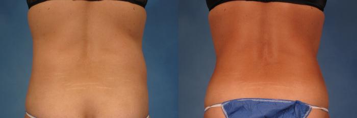Before & After Liposuction Case 216 View #2 View in Naples and Ft. Myers, FL