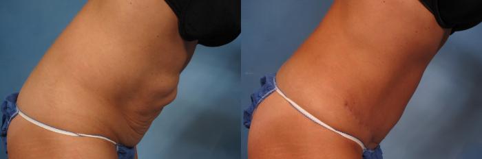 Before & After Liposuction Case 216 View #3 View in Naples and Ft. Myers, FL