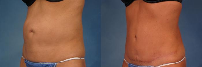 Before & After Liposuction Case 216 View #4 View in Naples and Ft. Myers, FL