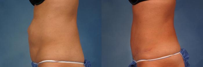 Before & After Liposuction Case 216 View #5 View in Naples and Ft. Myers, FL