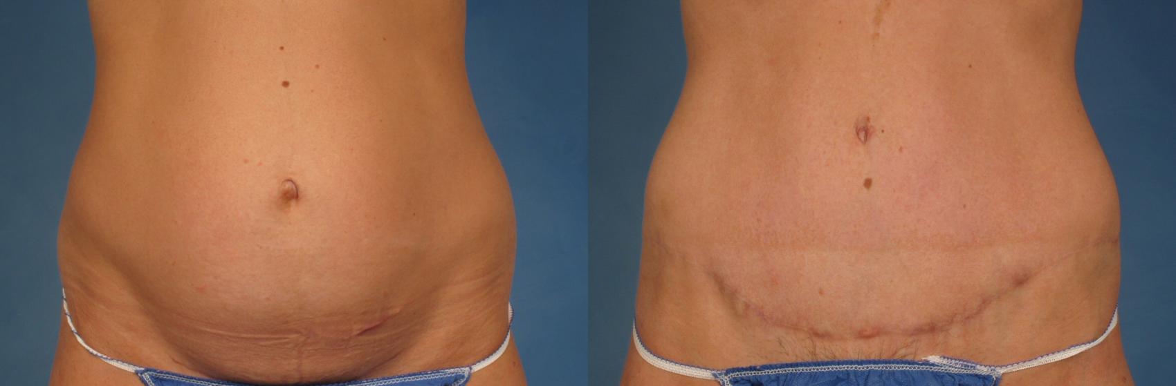 Before & After Liposuction Case 236 View #1 View in Naples and Ft. Myers, FL