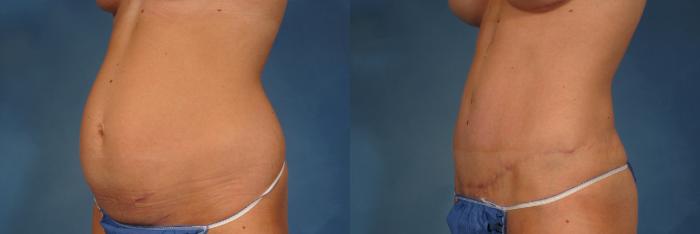 Before & After Liposuction Case 236 View #2 View in Naples and Ft. Myers, FL