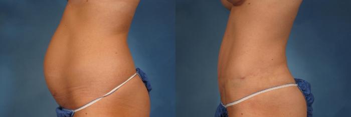 Before & After Liposuction Case 236 View #3 View in Naples and Ft. Myers, FL