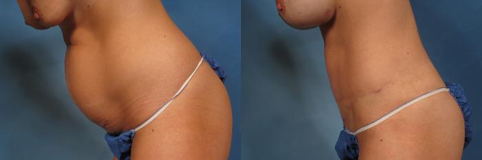 Before & After Liposuction Case 236 View #4 View in Naples and Ft. Myers, FL