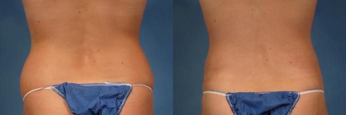 Before & After Liposuction Case 236 View #5 View in Naples and Ft. Myers, FL